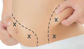 LIPOSUCTION